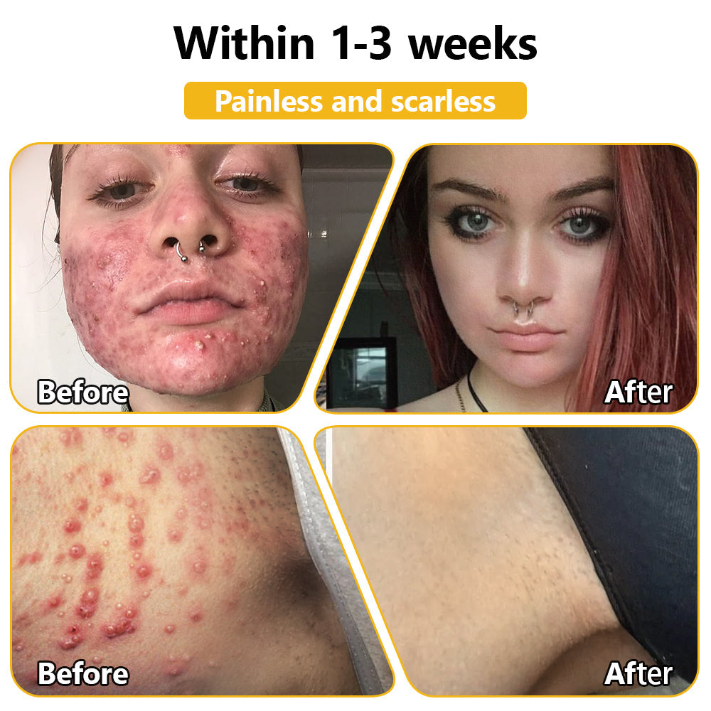ApisDerm™ Advanced Bee Venom Skin Treatment Cream