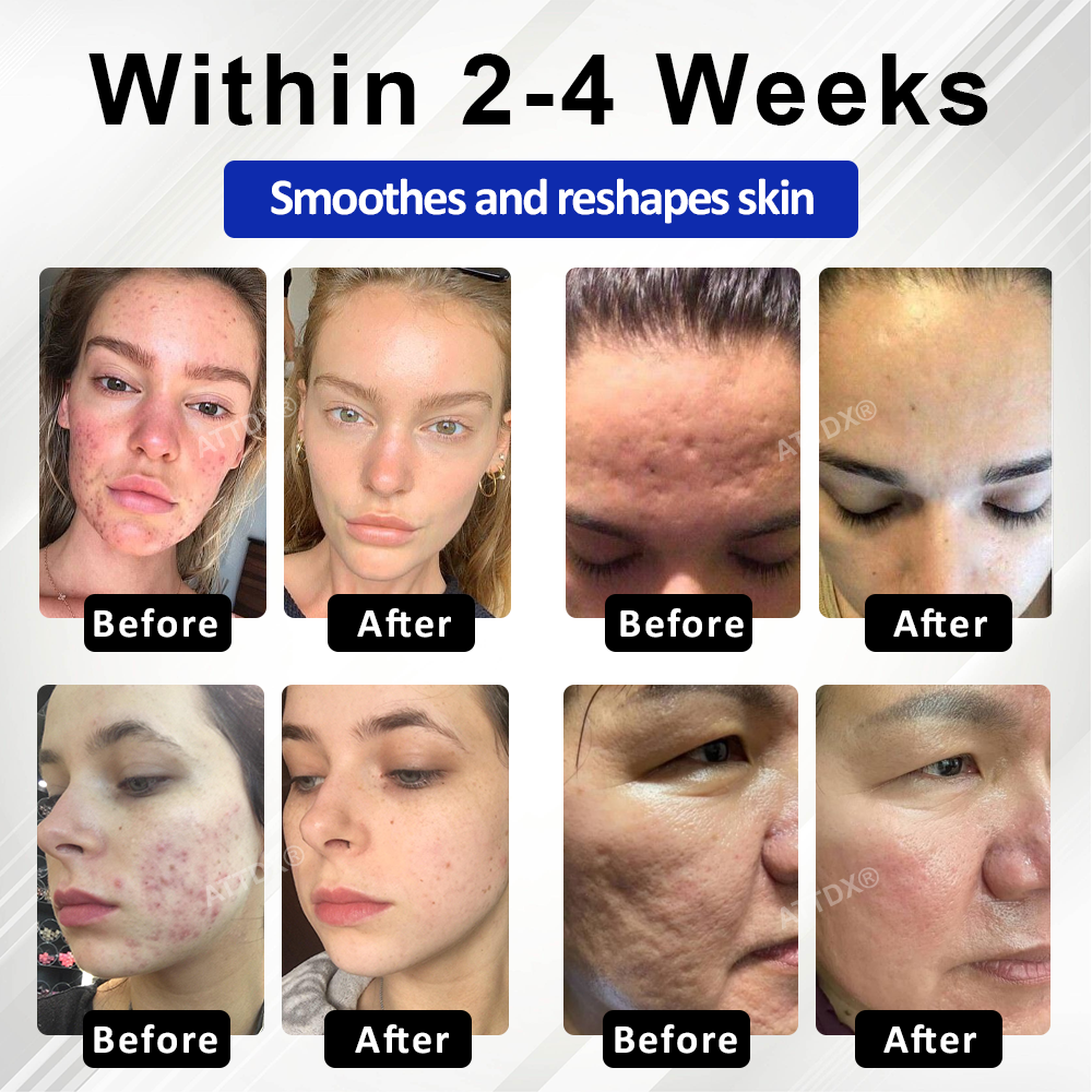 🔥TikTok Hot Sellers- ATTDX® ExoRefine Microneedling Liquid Essence