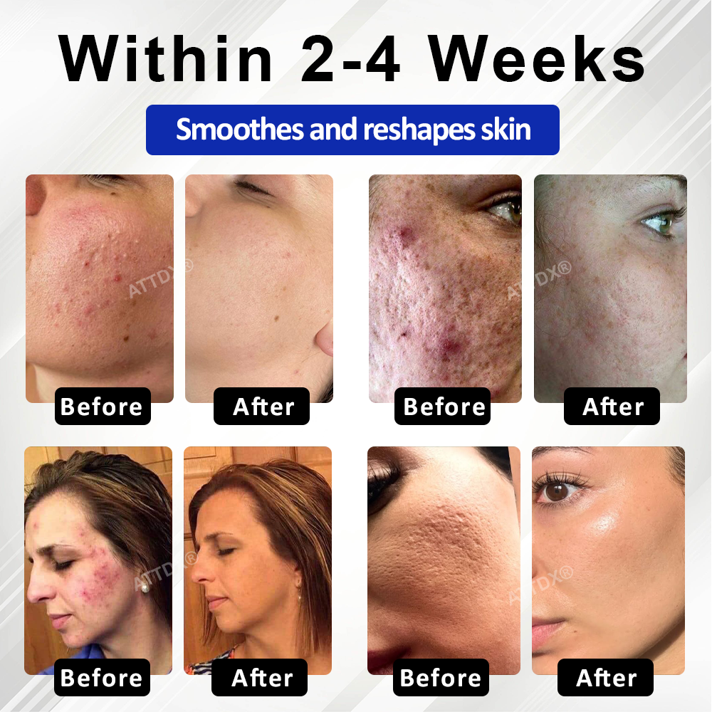 🔥TikTok Hot Sellers- ATTDX® ExoRefine Microneedling Liquid Essence