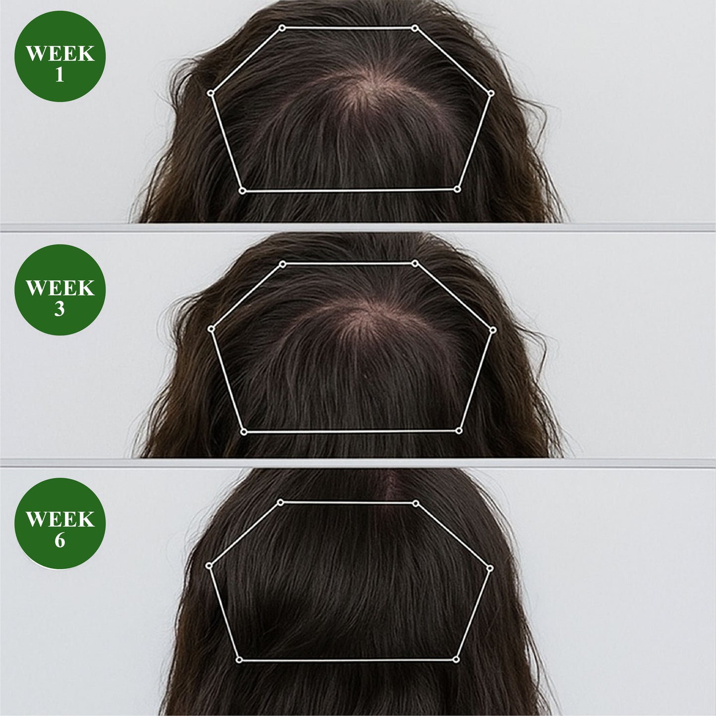 🔥TikTok Hot Sellers- ATTDX® LadyGro EGCG Microneedle Scalp Essence Kit