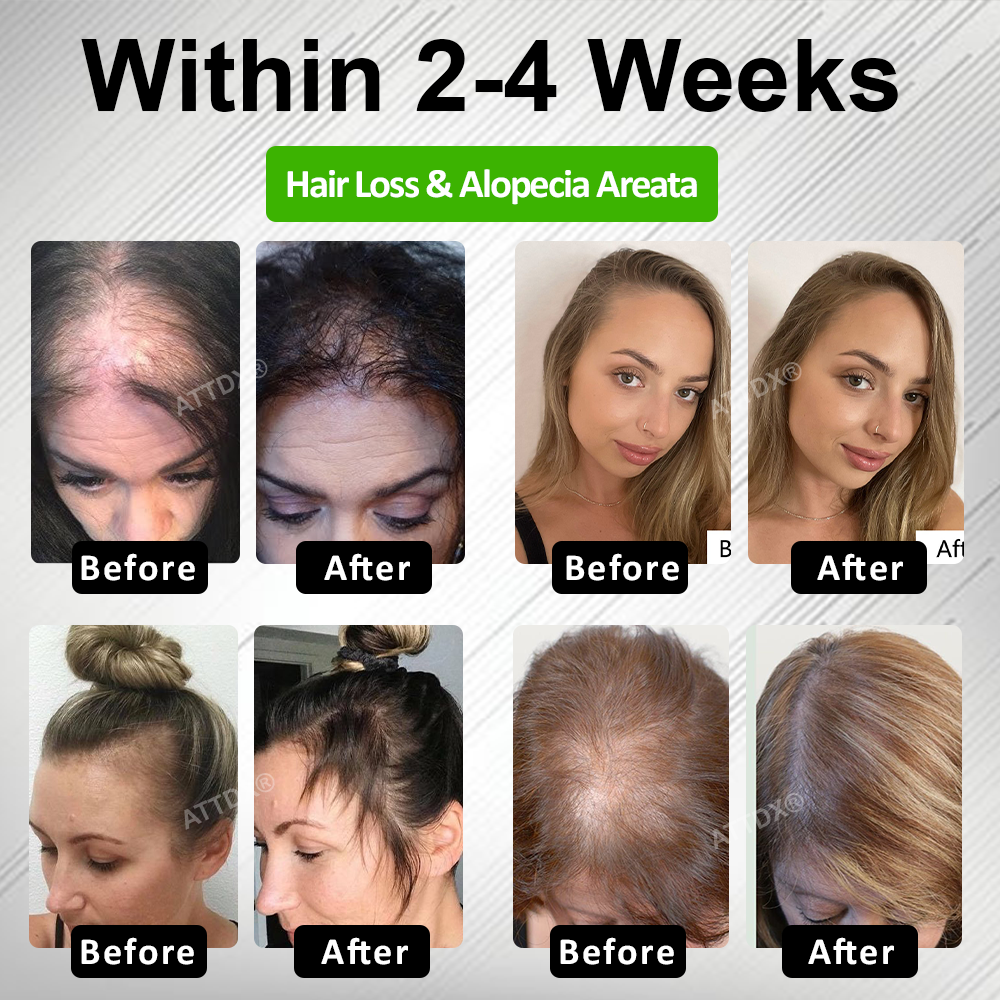🔥TikTok Hot Sellers- ATTDX® LadyGro EGCG Microneedle Scalp Essence Kit
