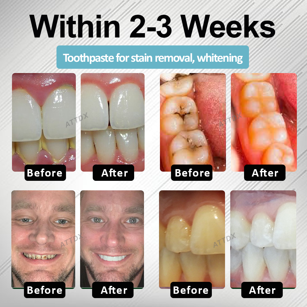 🔥TikTok Hot Sellers- ATTDX® MaxNHA Whitening Repair Toothpaste
