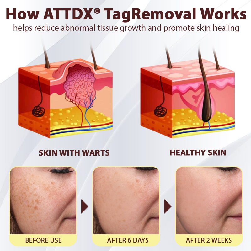 ATTDX® TagRemoval Sophora Herbal Cream