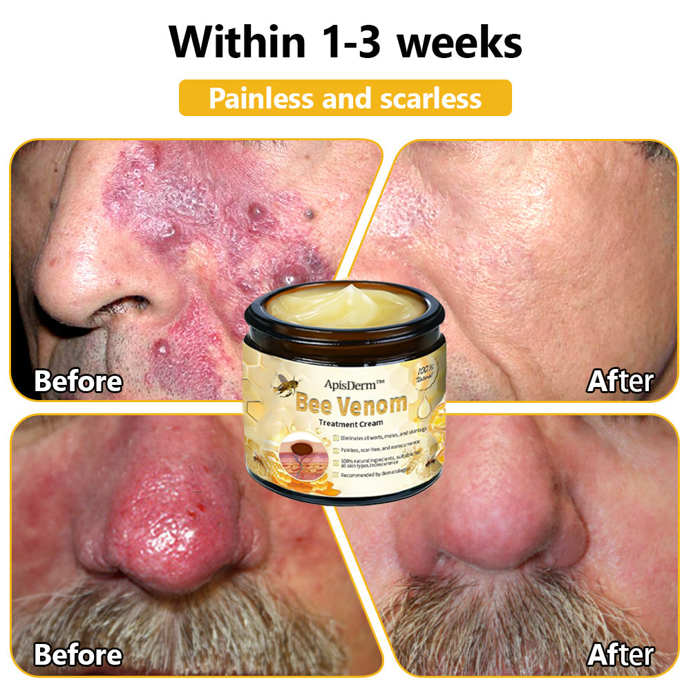 ApisDerm™ Advanced Bee Venom Skin Treatment Cream