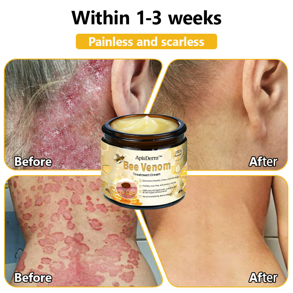 ApisDerm™ Advanced Bee Venom Skin Treatment Cream