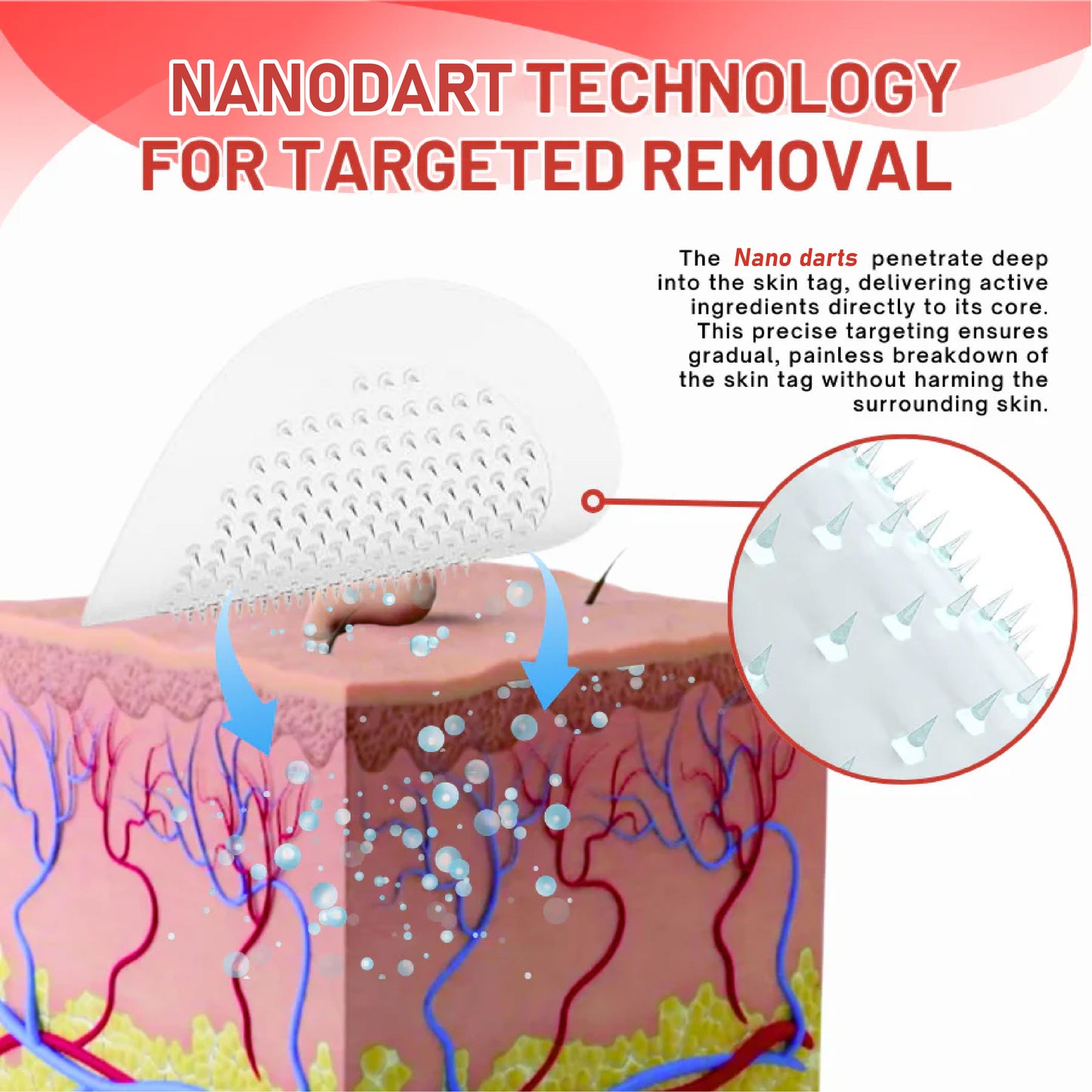DermaEase™ NanoDart Skin Tag Removal Patches