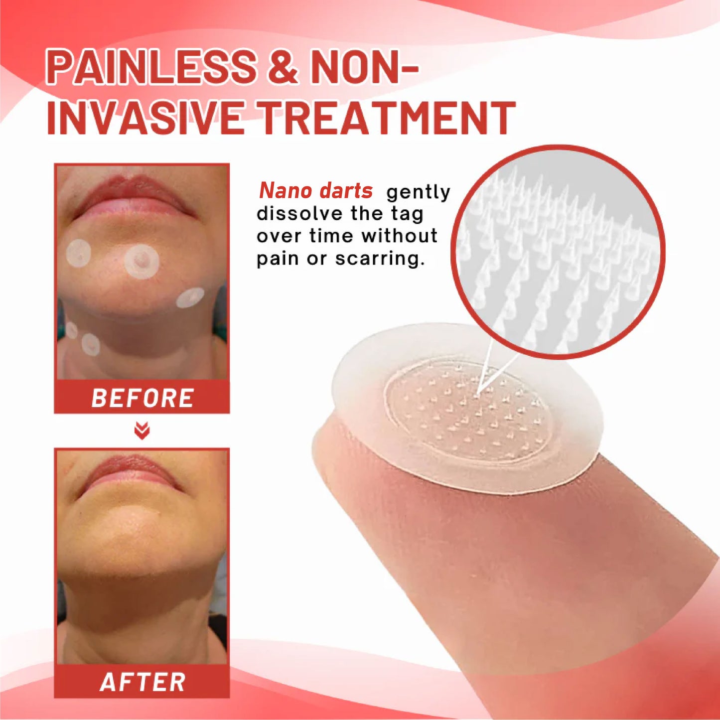 DermaEase™ NanoDart Skin Tag Removal Patches