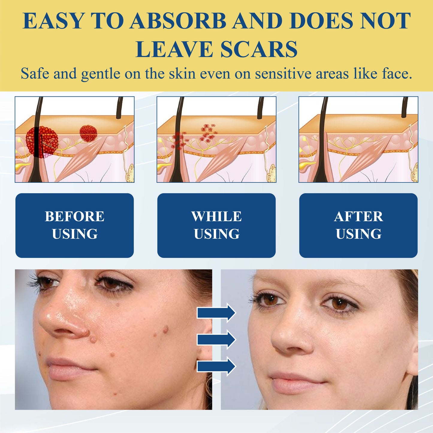DermaEase™ Nevus Removal Cream