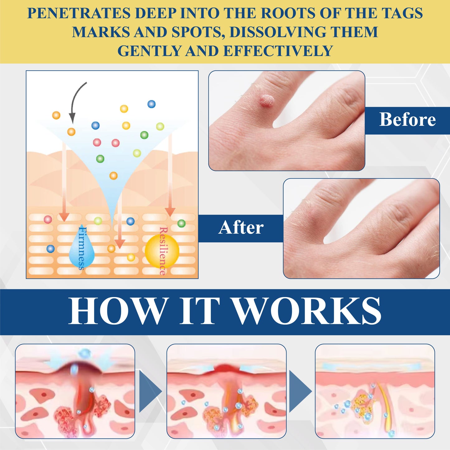 DermaEase™ Nevus Removal Cream