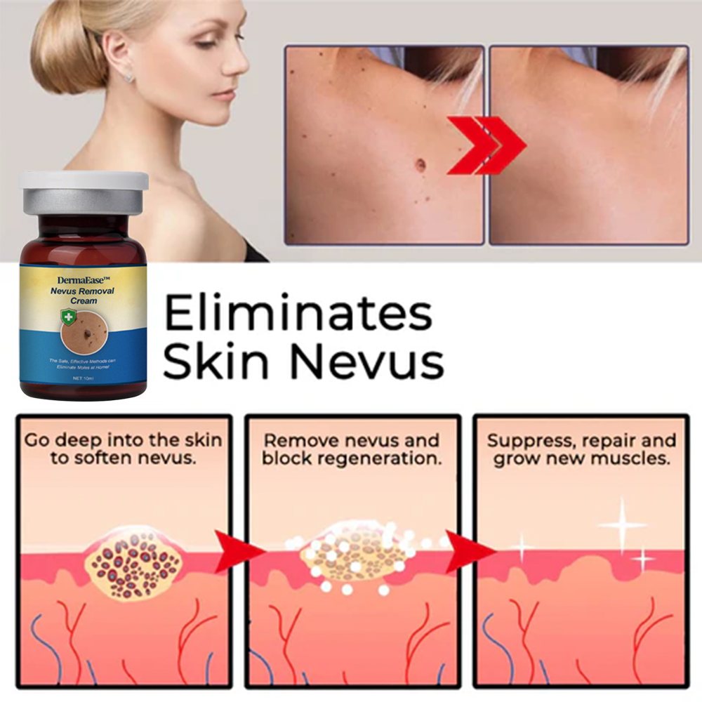 DermaEase™ Nevus Removal Cream