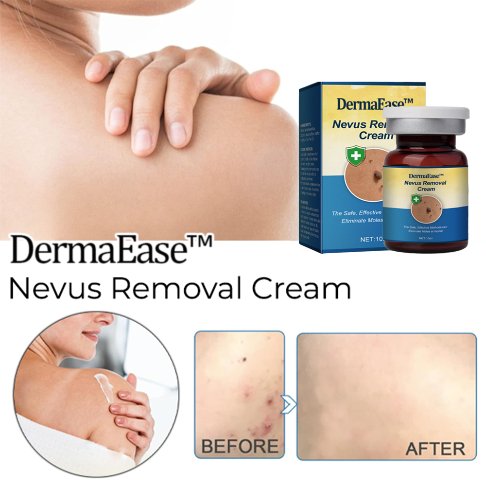 DermaEase™ Nevus Removal Cream