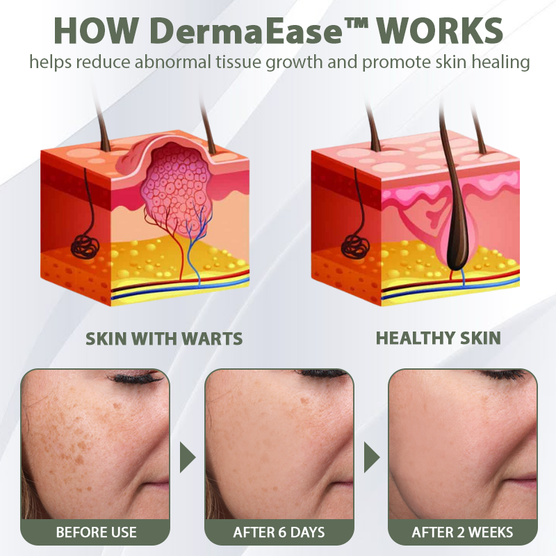 DermaEase™ Natureerase Instant Mole Spot Removal Gel