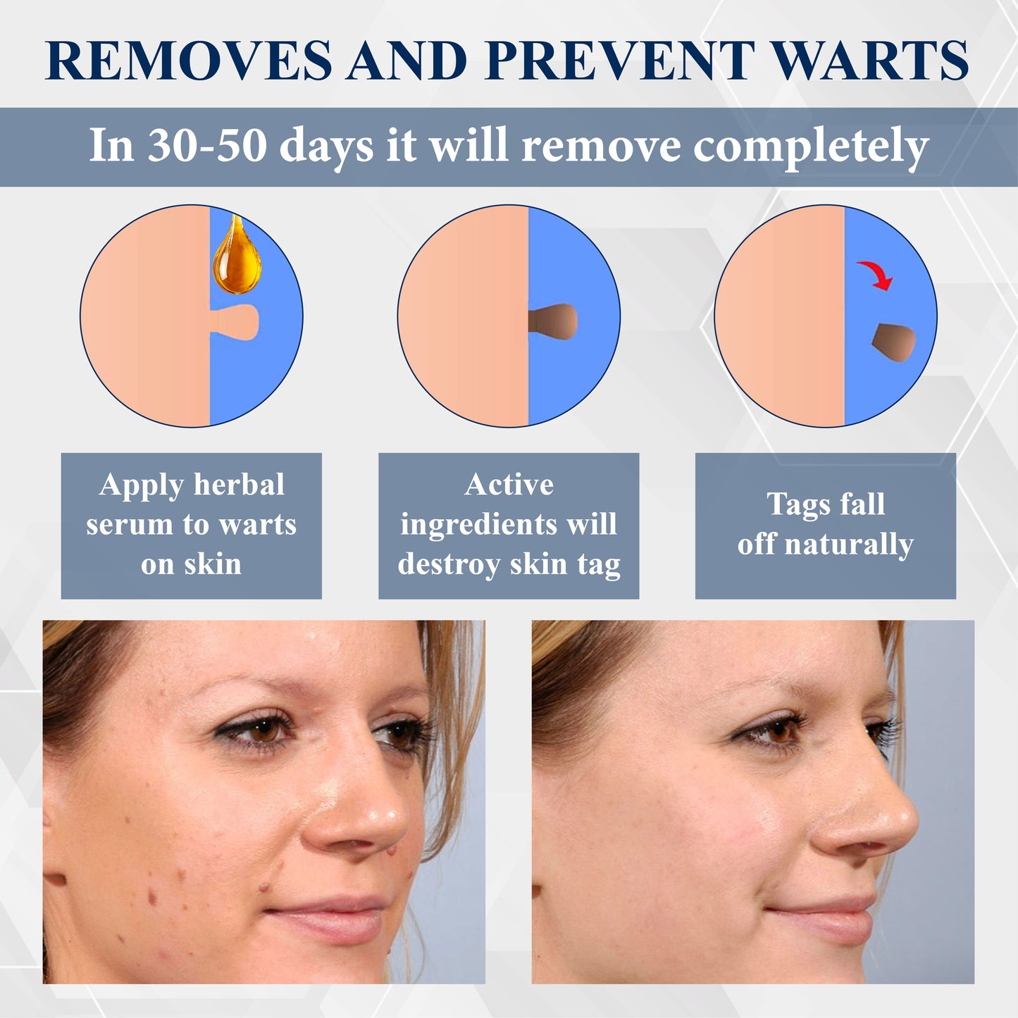 DermaEase™ Tag Wart Removal Herbal Serum