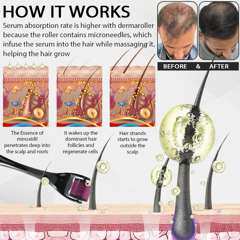 🔥TikTok Hot Sellers- ATTDX® Max Absorb MinoxidilSerum Dermaroller Kit