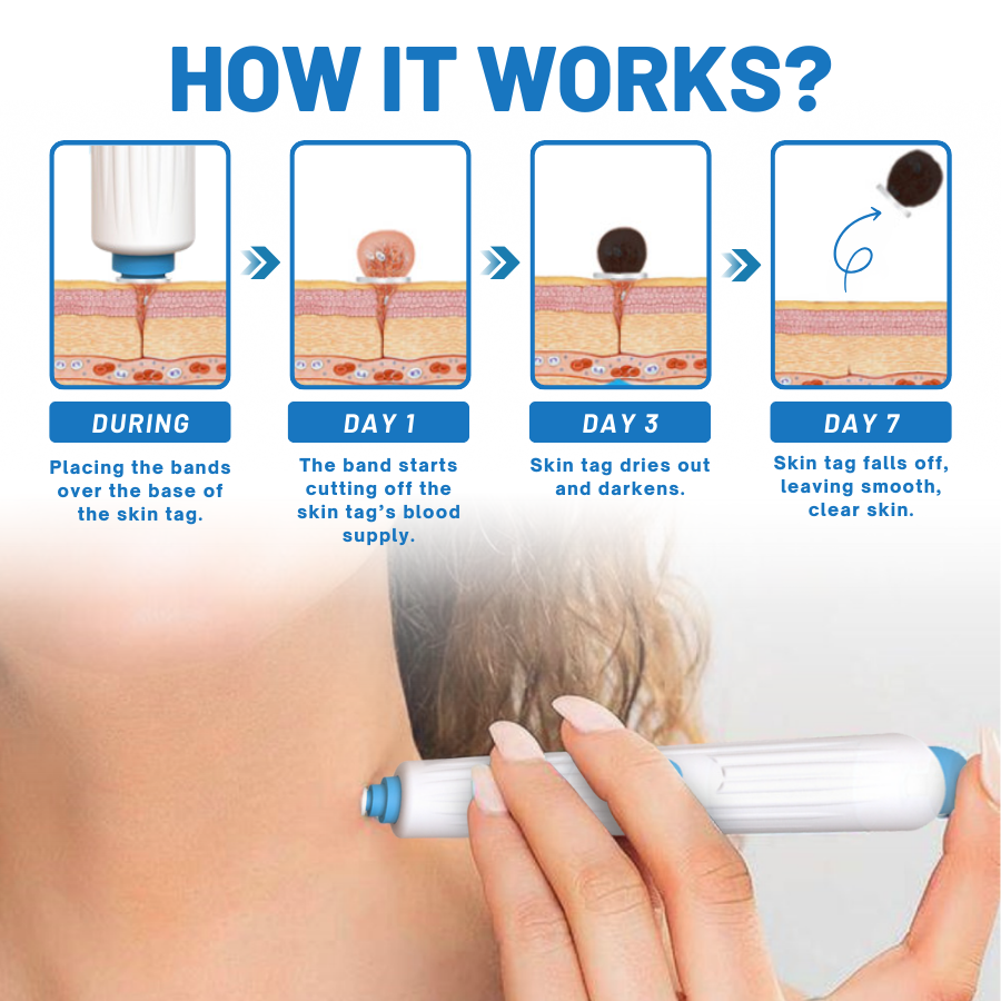 DermaEase™ Gentle Heal Skin Tag Pen Kit