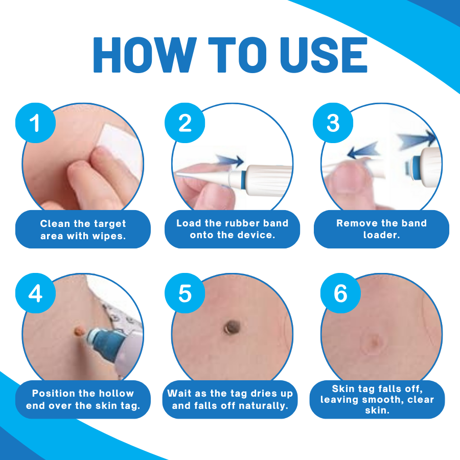 DermaEase™ Gentle Heal Skin Tag Pen Kit