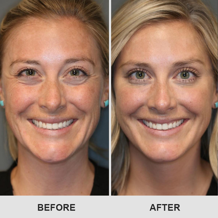 DermaEase⢠Retinol Eye Stick