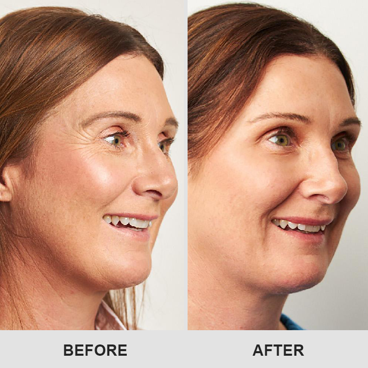 DermaEase⢠Retinol Eye Stick