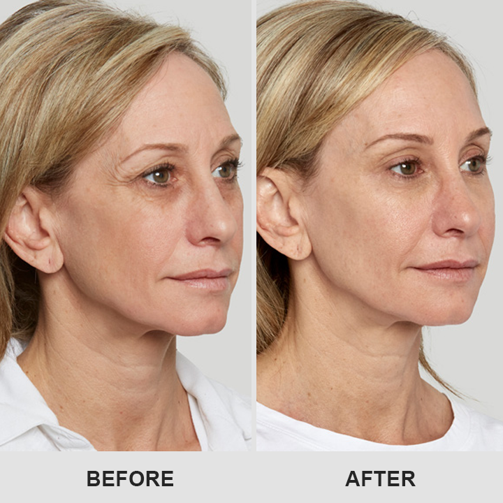 DermaEase⢠Retinol Eye Stick