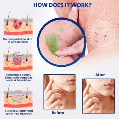 DermaEase™ NatureErase Ultra Instant Mole & Spot Cream