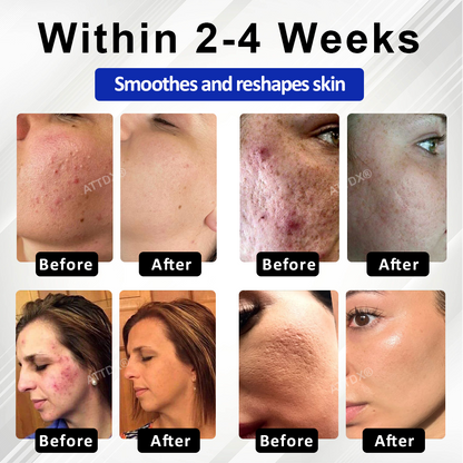 🔥TikTok Hot Sellers- ATTDX® ExoRefine Microneedling Liquid Essence