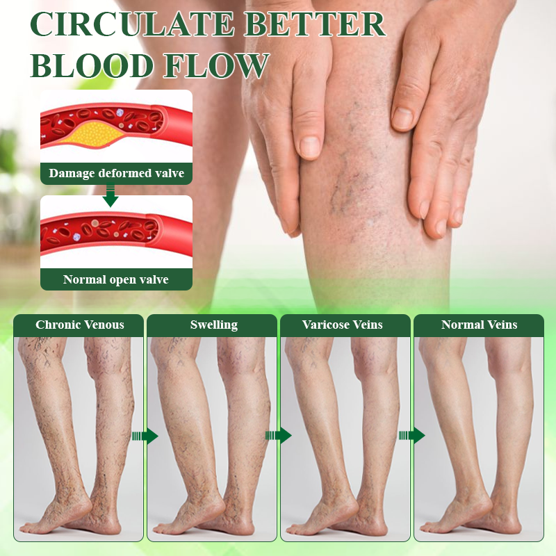 🔥TikTok Hot Sellers- ATTDX® VeinoRoll Therapy Edema Comfort Cream