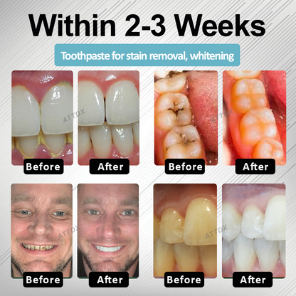 🔥TikTok Hot Sellers- ATTDX® MaxNHA Whitening Repair Toothpaste