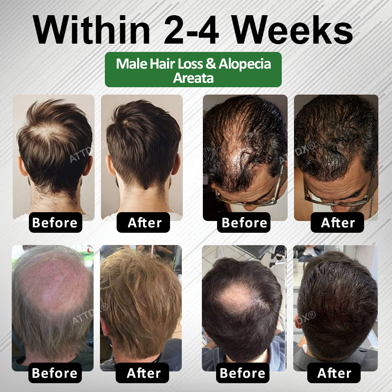 🔥TikTok Hot Sellers- ATTDX® ReGain+ Density Renewal Hair Serum