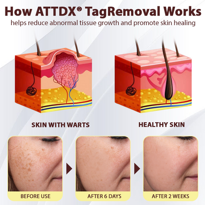 ATTDX® TagRemoval Sophora Herbal Cream