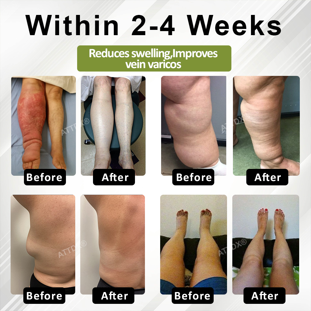 🔥TikTok Hot Sellers- ATTDX® VeinoRoll Therapy Edema Comfort Cream
