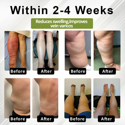🔥TikTok Hot Sellers- ATTDX® VeinoRoll Therapy Edema Comfort Cream