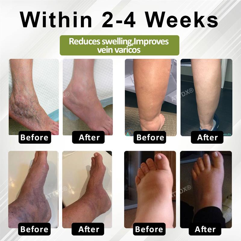 🔥TikTok Hot Sellers- ATTDX® VeinoRoll Therapy Edema Comfort Cream