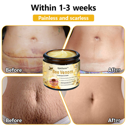 ApisDerm™ Advanced Bee Venom Skin Treatment Cream