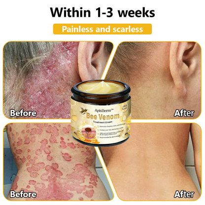 ApisDerm™ Advanced Bee Venom Skin Treatment Cream
